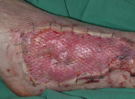 Skin Grafting at UMANG Hospital