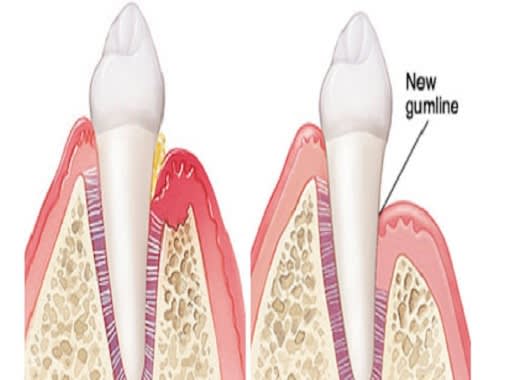 Flap Surgery at UMANG Hospital