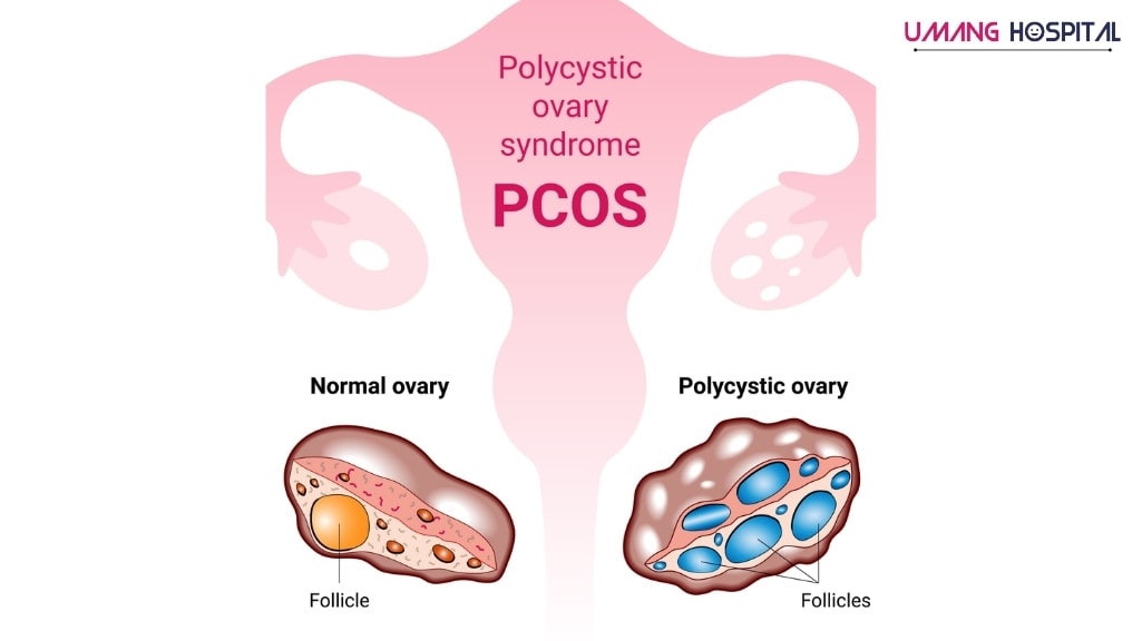 POLYCYSTIC OVARIAN SYNDROME/ PCOS CLINIC at UMANG Hospital