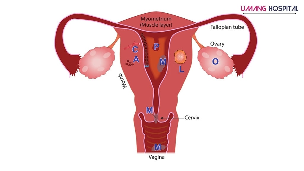 MENSTRUAL DISORDERS at UMANG Hospital