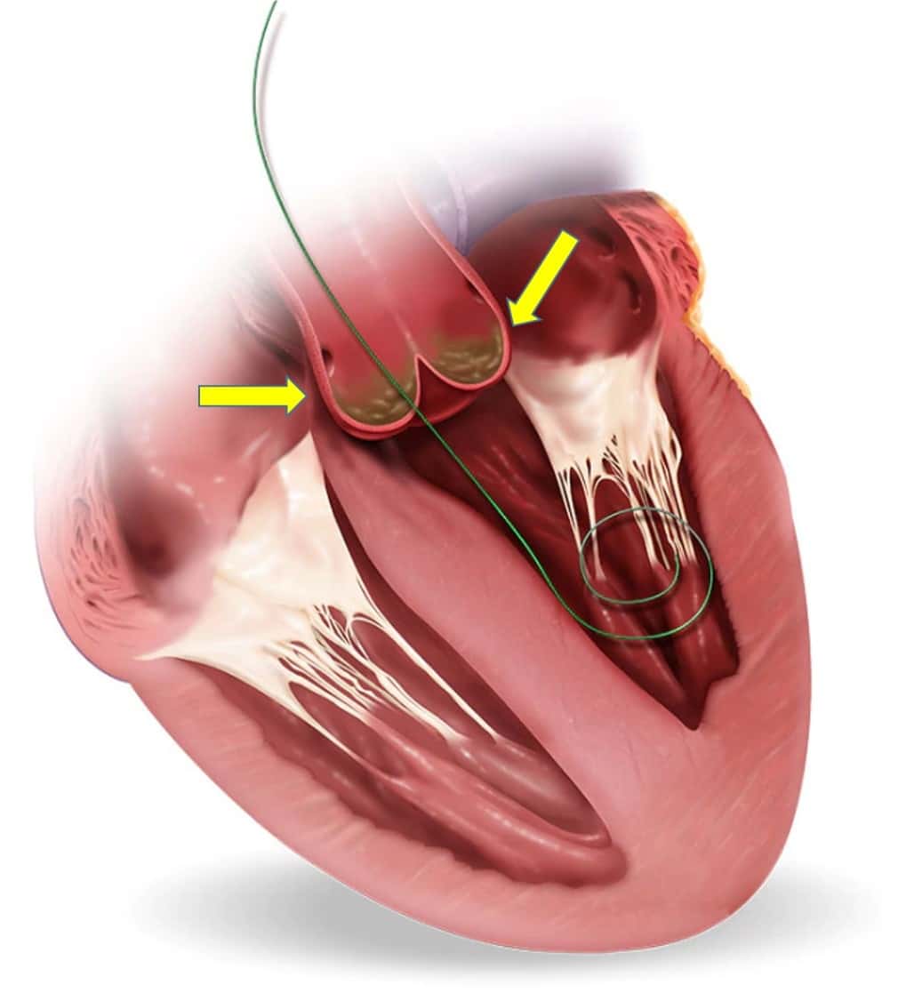 Valvular Interventions (TAVI) at UMANG Hospital