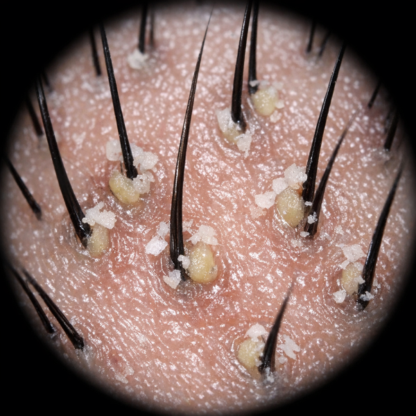 Scalp under a dermoscope before: plugged follicle openings and flakes