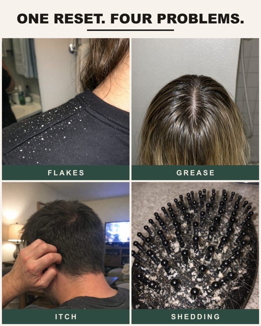 One reset, four problems: flakes, grease, itch, shedding