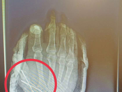 Опасный инструмент: врачи спасли дачнику палец, отрезанный болгаркой