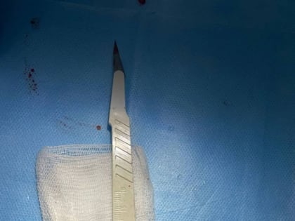 Урологи Ижевска достали из пациента камень диаметром 4 сантиметра