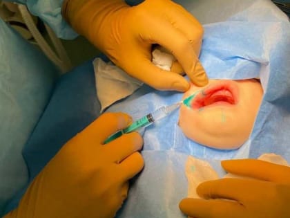 Успешная операция по устранению расщелины губы у девочки в Абакане