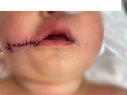 Успешное лечение врождённой расщелины губы у ребёнка в Абакане