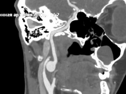Красноярские медики обнаружили у пациентки из Хакасии опасную аневризму в необычном месте