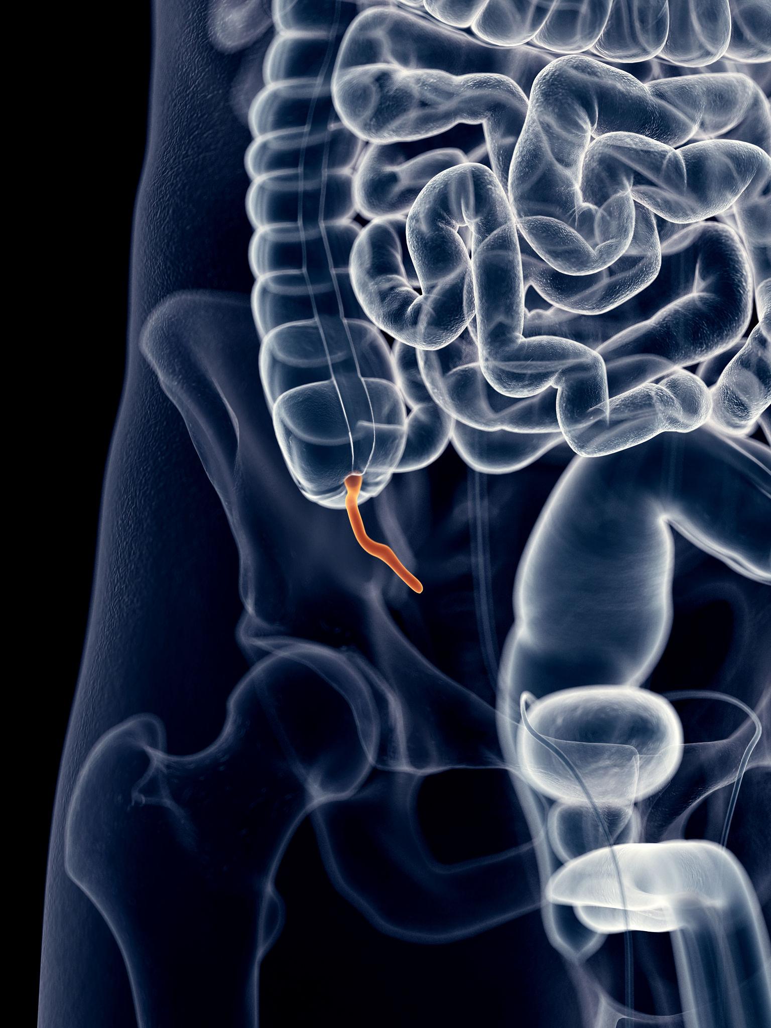 Appendicitis: Symptoms, Treatment & Recovery Guide