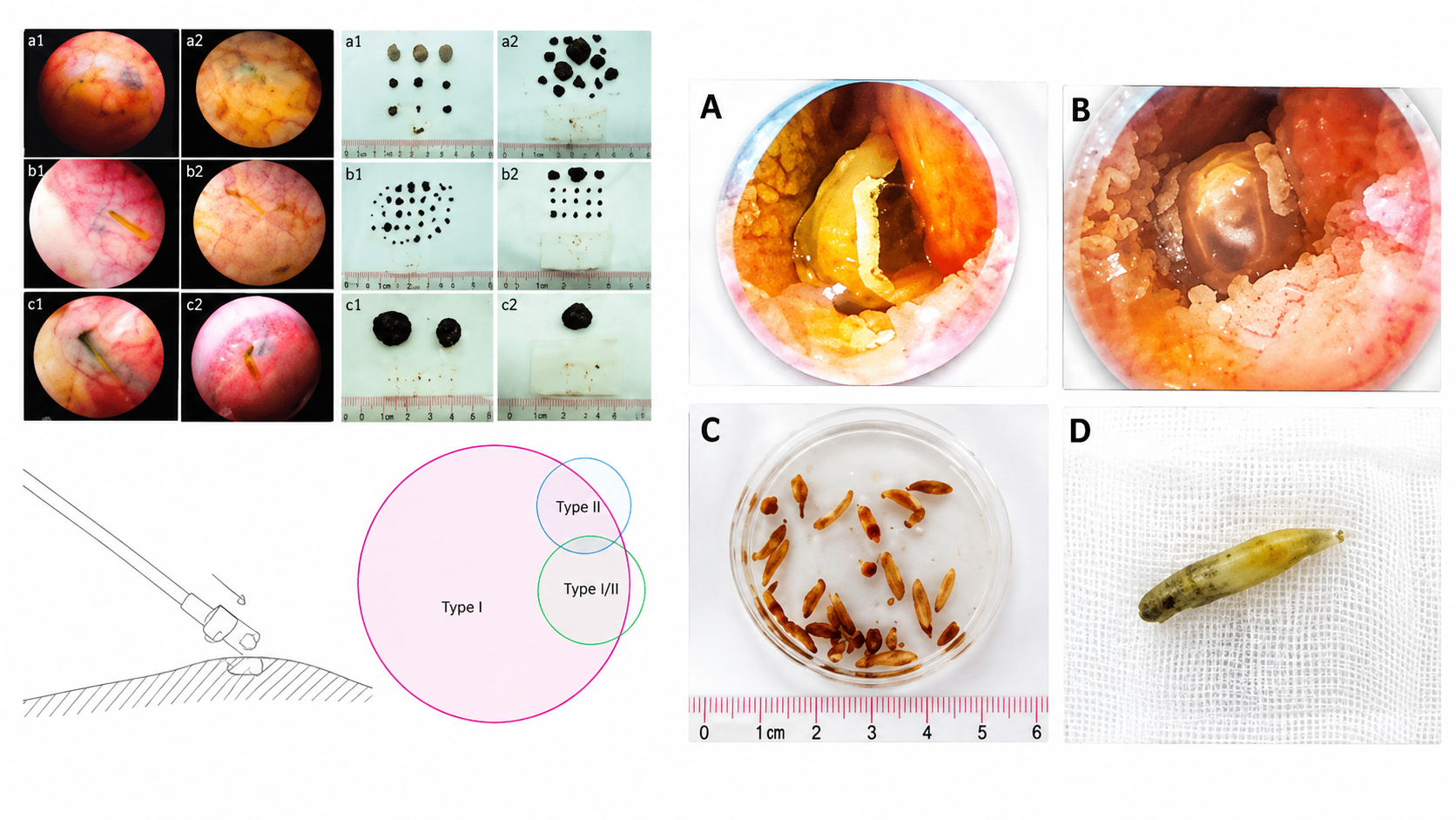 Real Gallbladder Stones: What They Actually Look Like vs. Online ...