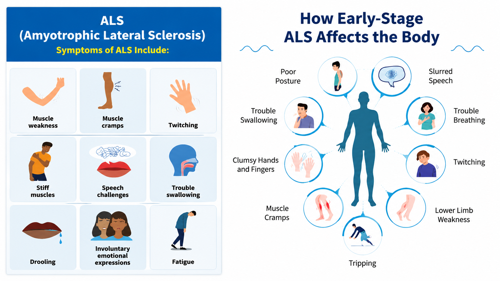 ALS Disease: A Comprehensive Guide to Understanding Symptoms, Diagnosis ...