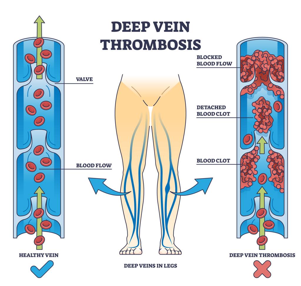 Deep Vein Thrombosis (DVT): Symptoms, Warning Signs, Causes & Modern ...