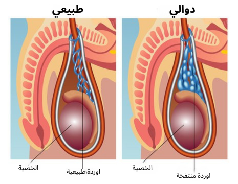 دوالي الخصية: فهم الحالة وخيارات العلاج الجراحي