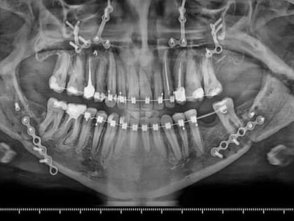 Волгоградские челюстно-лицевые хирурги исправили пациентке неправильный прикус