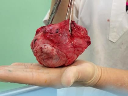 Волгоградские хирурги во время родов удалили женщине миому размером с кулак