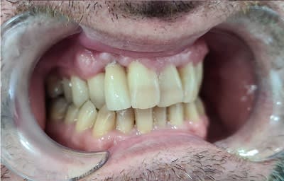 Prótesis fija sobre implante - Después