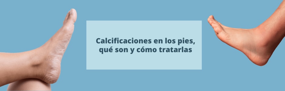 Calcificaciones en los pies, qué son y cómo tratarlas
