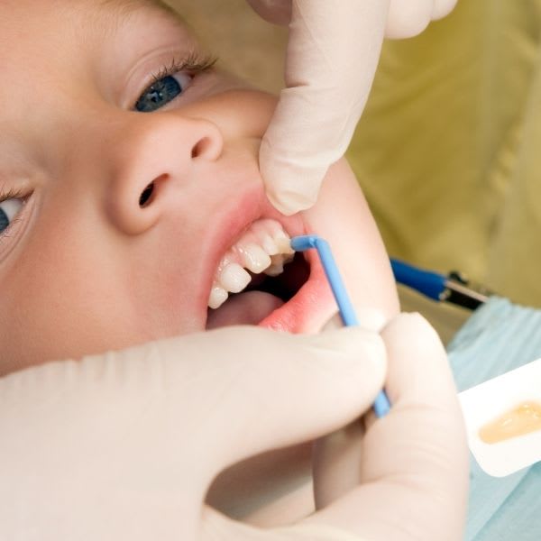 Fluor dental dentista infantil