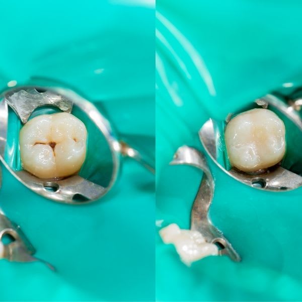 empaste dental<br />
