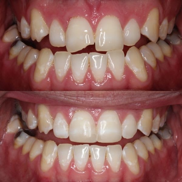 reconstrucción dental