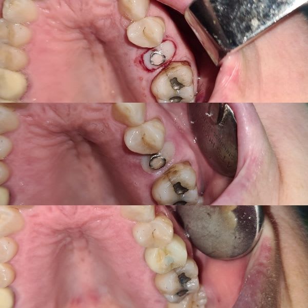 regeneración osea dental