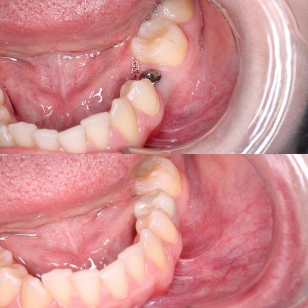 coronas dentales sobre implantes
