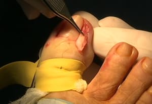 Uña encarnada Herrera