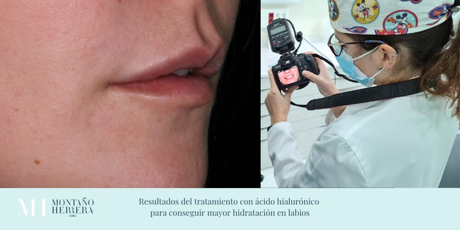 Resultados hidratación ácido hialurónico