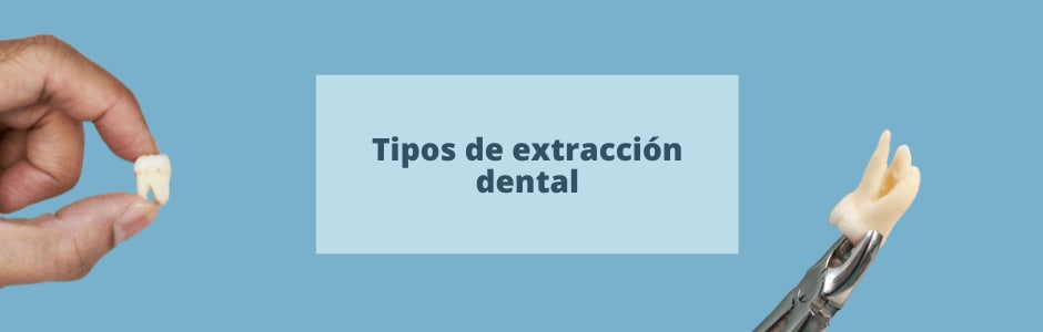 Tipos de extracción dental