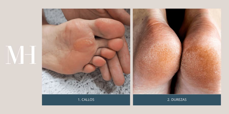 Ejemplo de callos y durezas