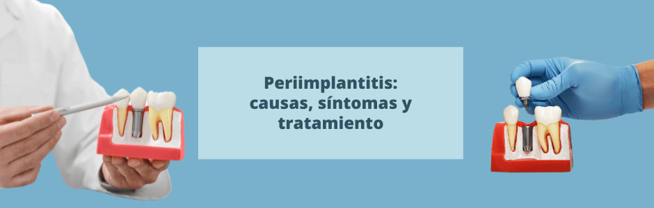 Periimplantitis: causas, síntomas y tratamiento