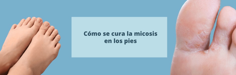 Cómo se cura la micosis en los pies