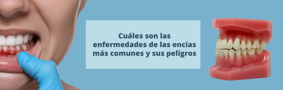 Cuáles son las enfermedades de las encías más comunes y cuáles son sus peligros