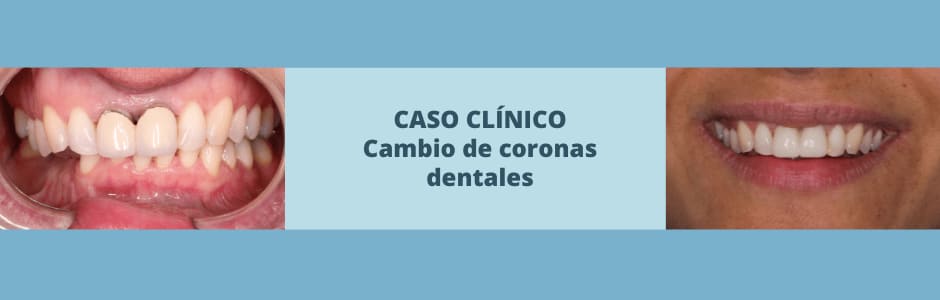 Caso clínico: cambio de coronas dentales de recubrimiento total