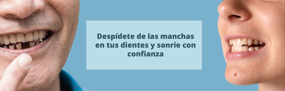 Despídete de las manchas en los dientes y sonríe con confianza