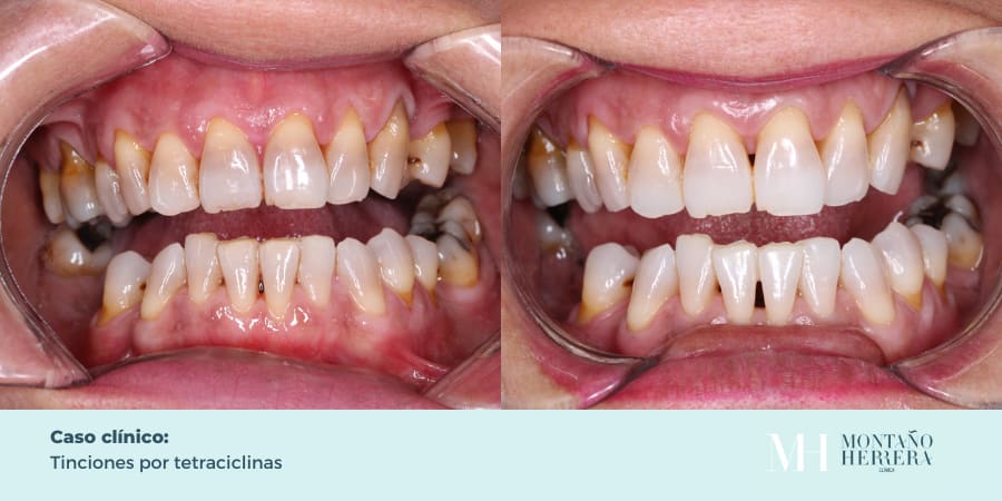 Tinciones por tetraciclinas