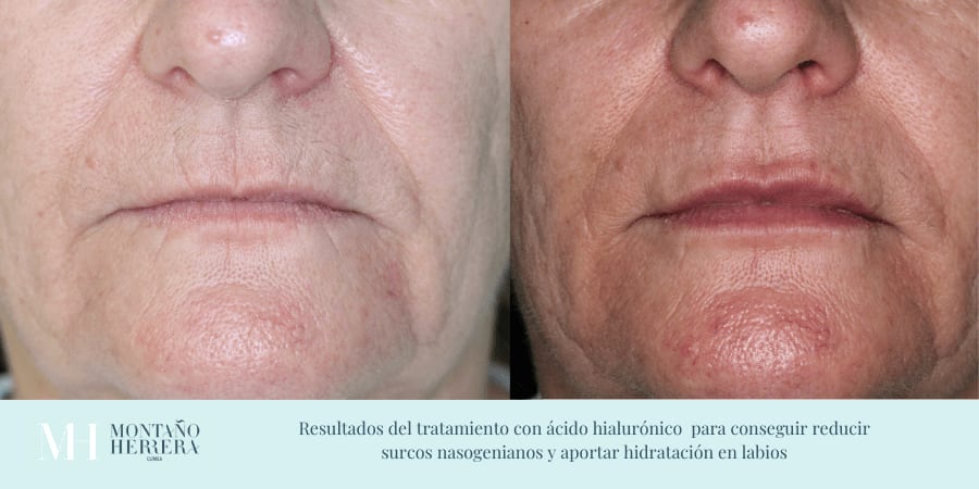 esultados del tratamiento con ácido hialurónico
