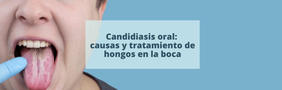 Candidiasis oral: causas y tratamiento de hongos en la boca