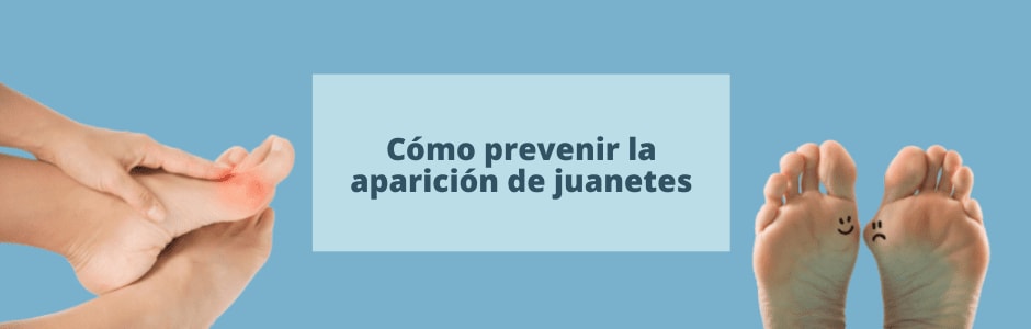 Cómo prevenir la aparición de juanetes