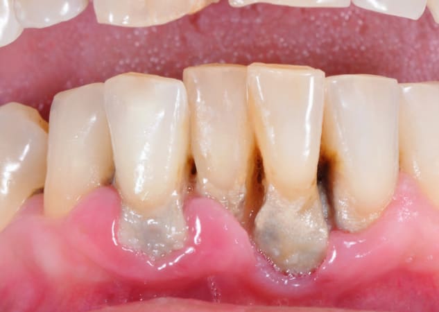 Caso de periodontitis