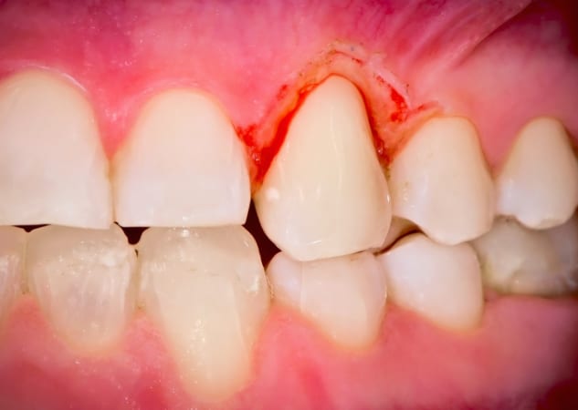 Caso de gingivitis