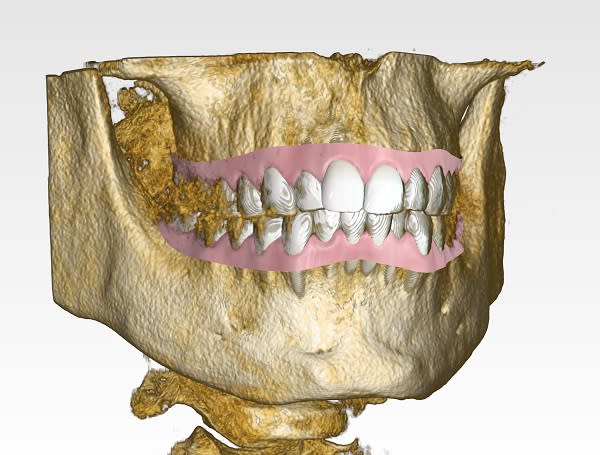 CBCT con escáner intraoral donde estamos planificando evolución y movimientos de un tratamiento de ortodoncia invisible