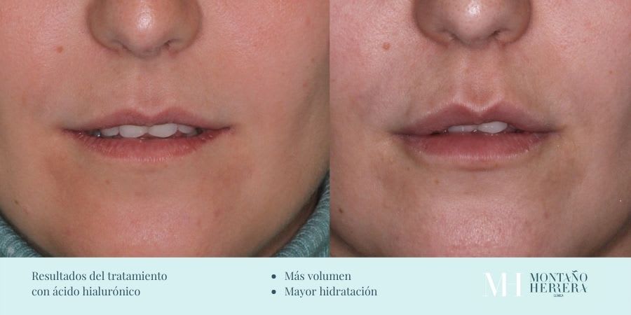 Resultados tratamiento ácido hialurónico en Herrera de frente