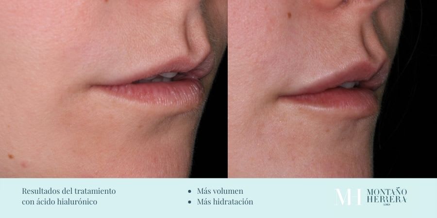 Resultados tratamiento ácido hialurónico en Herrera