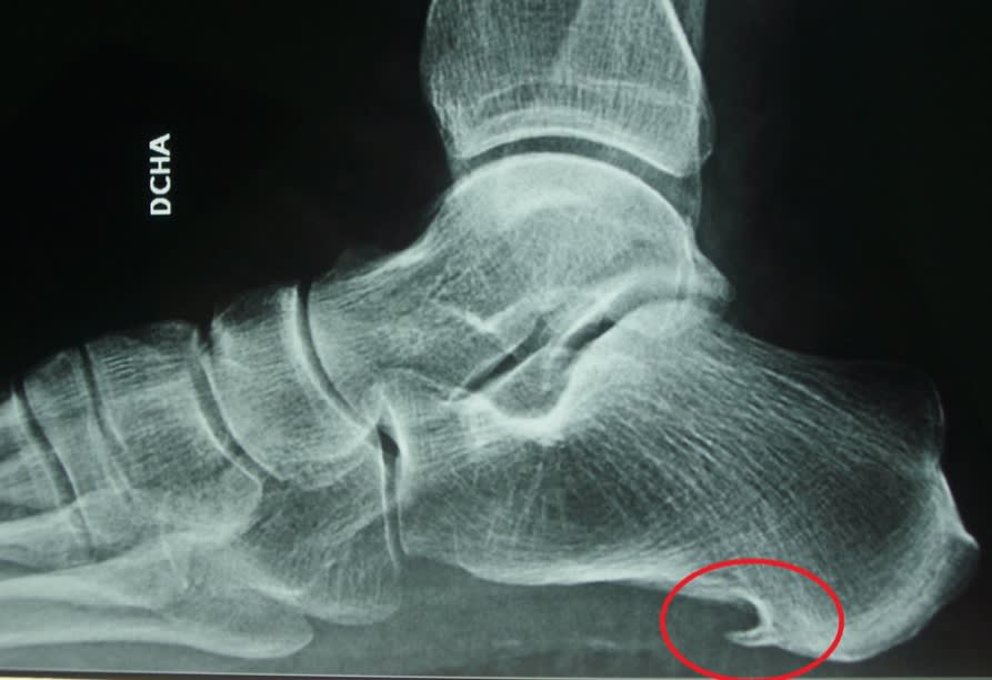 Espolón en el Talón - Podólogo en Herrera