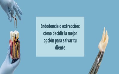 Endodoncia o extracción: cómo decidir la mejor opción para salvar tu diente