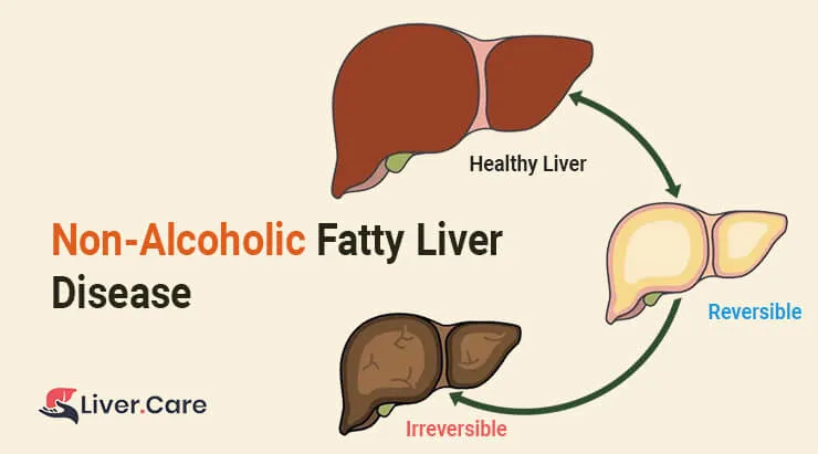 Understanding Non-Alcoholic Fatty Liver: A Growing Health Concern