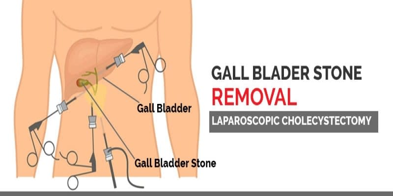 Gall Bladder Stone Removal Surgery in Ludhiana | Gallbladder Hospital ...