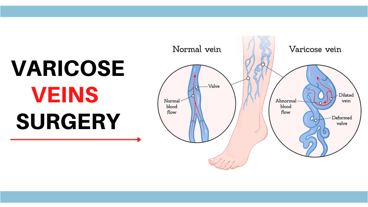 Varicose Veins Surgery | #1 | STAR Hospital