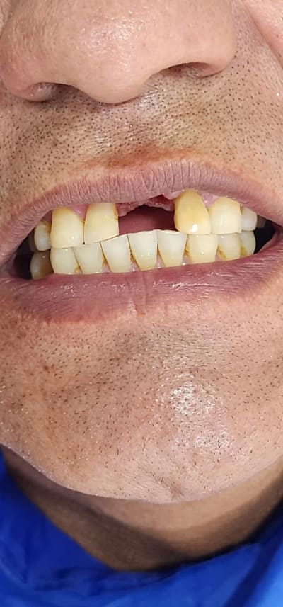 Antes: Implantes dentales